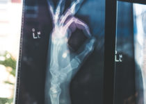 Las fracturas óseas curan más rápido con medicación